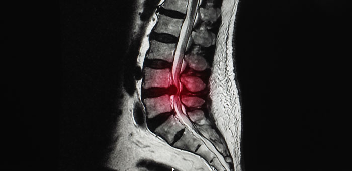 patient suffering from herniated disc needing a chiropractor in Valley Village